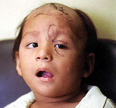 Grosse Verletzungen im Gesicht
                                    durch einen Haushund