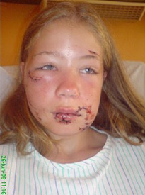 Heridas en la cara por un perro
                                    pastor [16]. El ni�o de 11 a�os fue
                                    atacado en Munich (Alemania) por un
                                    perro pastor un territorio de
                                    deportes [9].