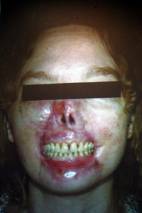 La mujer Isabelle Dinoire (38
                                    a�os) de Valenciennes (Francia) sin
                                    labios y sin la mitad de la nariz
                                    [98]