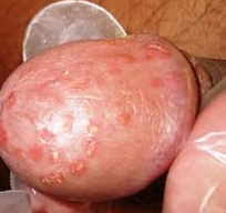 Herpes genitalis am Penis an der Eichel