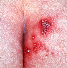 Herpes
                  genitalis an der Arschbacke