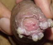 Des verrues de condylomes sur le pr�puce