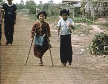 Minenopfer: M�dchen mit nur einem
                  Bein in Asien (Region Kambodscha, Burma und Laos)