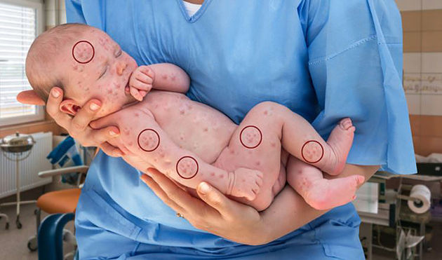 Kriminelle NWO-NBC manipuliert das gesunde Baby auf
                dem Foto mit Photoshop-Masernpusteln - Markierungen