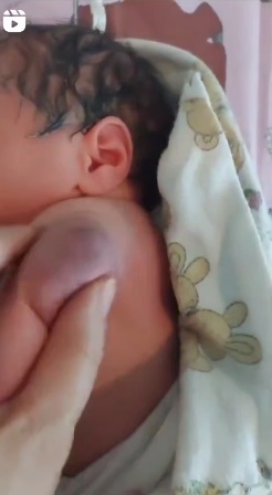 Impfschaden beim Baby ohne Ort am 9.12.2024:
                geschwollene Impfstelle, so dick wie der Arm selber