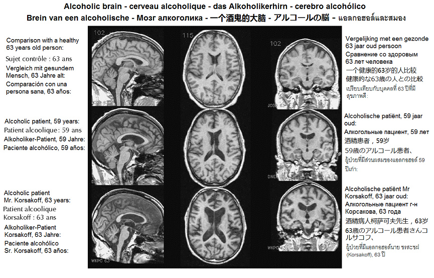 Grosse Löcher im Hirn und
                                  Zerstörung ganzer Hirnbereiche bei
                                  einem 57 und 63 Jahre alten
                                  Alkoholiker mit Vergleichsfoto