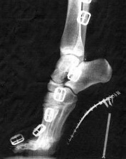 Ein Fuss in einem
                        High-Heel-Schuh, Röntgenfoto der deformierten
                        Fussstellung. Das Hauptgewicht liegt auf den
                        Zehenballen, und das ergibt einen schmerzhaften
                        Spreizfuss.