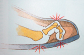 Darstellung eines Hammerzehs
                          (02): Hier sind das mittlere Glied und das
                          Endglied nach unten gerichtet, und
                          entsprechend sind zwei Zehengelenke überdehnt,
                          und am Zeh entwickeln sich gleich drei
                          Druckstellen mit Hühneraugen auf einmal.