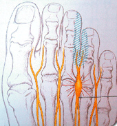 Die
                          Morton'sche Neuralgie (Morton'sche
                          Nervenschmerzen) entstehen, wenn die Nerven
                          durch Bänder zwischen den Zehen
                          zusammengedrückt werden, wenn also der Fuss
                          ein Spreizfuss wird, meist in Kombination mit
                          einer Schiefzehe (Hallux valgus).
                          Hauptursache: Stöckelschuhe [6].