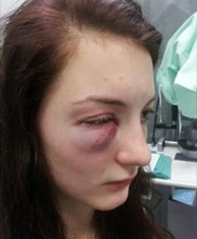 Die 19-jährige Angela D. zeigt im Fernsehen ihre
              Verletzung. Das Auge hat noch 16% Sehvermögen