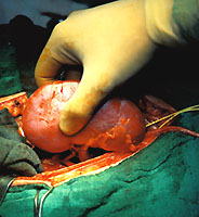 Quecksilber aus Amalgam wird ins Blut
                              �bertragen und reichert sich in den Nieren
                              an, ganz legal, ohne dass ein Richter
                              eingreifen w�rde...