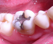 Jede
                        Amalgamf�llung gibt 24 Stunden t�glich
                        Quecksilber frei. Das BfArM macht dabei keine
                        Zahlenangaben. Das ist alles andere als
                        "wissenschaftlich"...