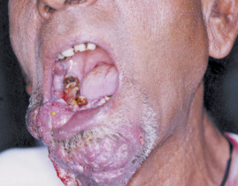 Mouth cancer