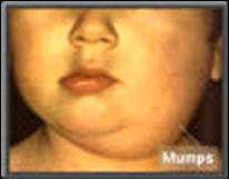 Mumps
                        ist bei Blutgruppe B besonders h�ufig