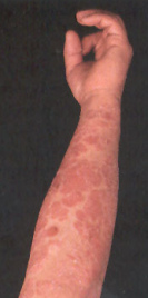 Schuppenflechte wird
                        durch Ern�hrung gegen die Blutgruppe provoziert,
                        vor allem bei Blutgruppe 0