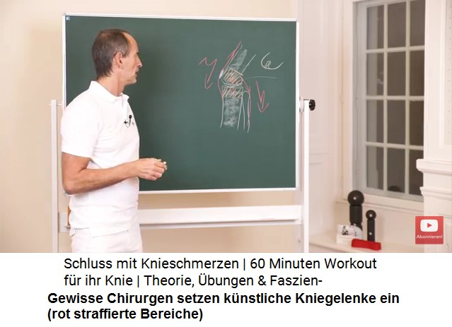 K�nstliches
                        Kniegelenk, Schema: Gewisse Chirurgen setzen
                        k�nstliche Kniegelenke ein (rot straffierte
                        Bereiche)