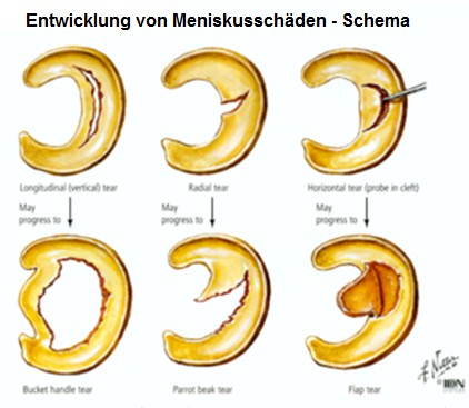 Die
                      Entwicklung von Meniskussch�den, Schema