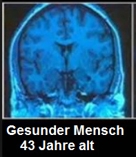 Hirn eines gesunden Menschen, 43 Jahre alt