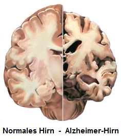 Vergleich normales Hirn und geschrumpftes
              Alzheimer Hirn