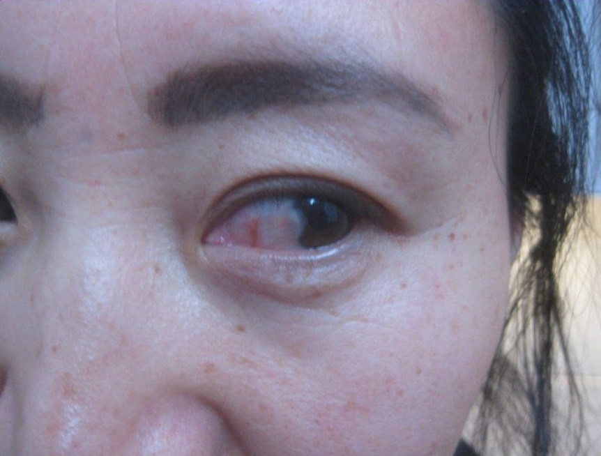 Uveitis am 24.12.2025: Augenentzündung
mit Eiter auf der Iris - täglich mit Kamillentee
auswaschen Uveitis am 24.12.2025:
Augenentzündung mit Eiter auf der Iris - täglich
mit Kamillentee auswaschen