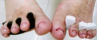 Abgeschliffene Fussn�gel