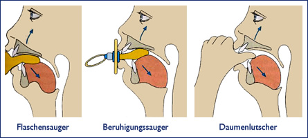 Zahnfehlstellung
                              (Darstellung) durch zu viel Saugen an
                              Saugern (Flaschensauger), Schnullern und
                              Nuggis (Beruhigungssauger) und durch zu
                              viel Daumenlutschen [5]: Die vorderen
                              Schneidez�hne werden nach oben gehoben
                              [8].