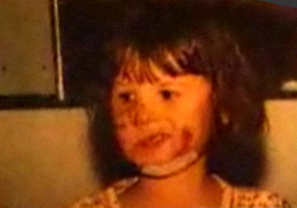 Grosse Verletzungen im Gesicht
                                  durch einen Rottweiler-Wachhund