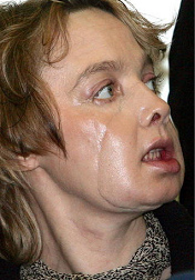 Isabelle Dinoire nach der
                                    Gesichtstransplantation