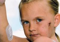 Das M�dchen Amber Churm aus
                                    Thurnscoe in der Provinz South Yorks
                                    in England zeigt ihre Verletzungen
                                    im Gesicht und am Arm, die von einem
                                    aggressiven Staffordshire Bull
                                    Terrier stammen