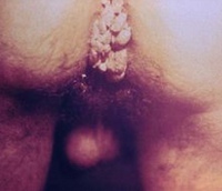 Condylomata warts on the anus