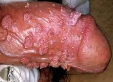 Condylomata warts on the penis