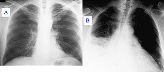 ... hasta el ni�o
                      negro recibi� una pulmon�a fuerte.